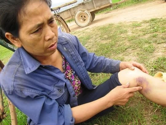 Một người dân xã Bắc Sơn chỉ cho PV xem vết thương ở chân