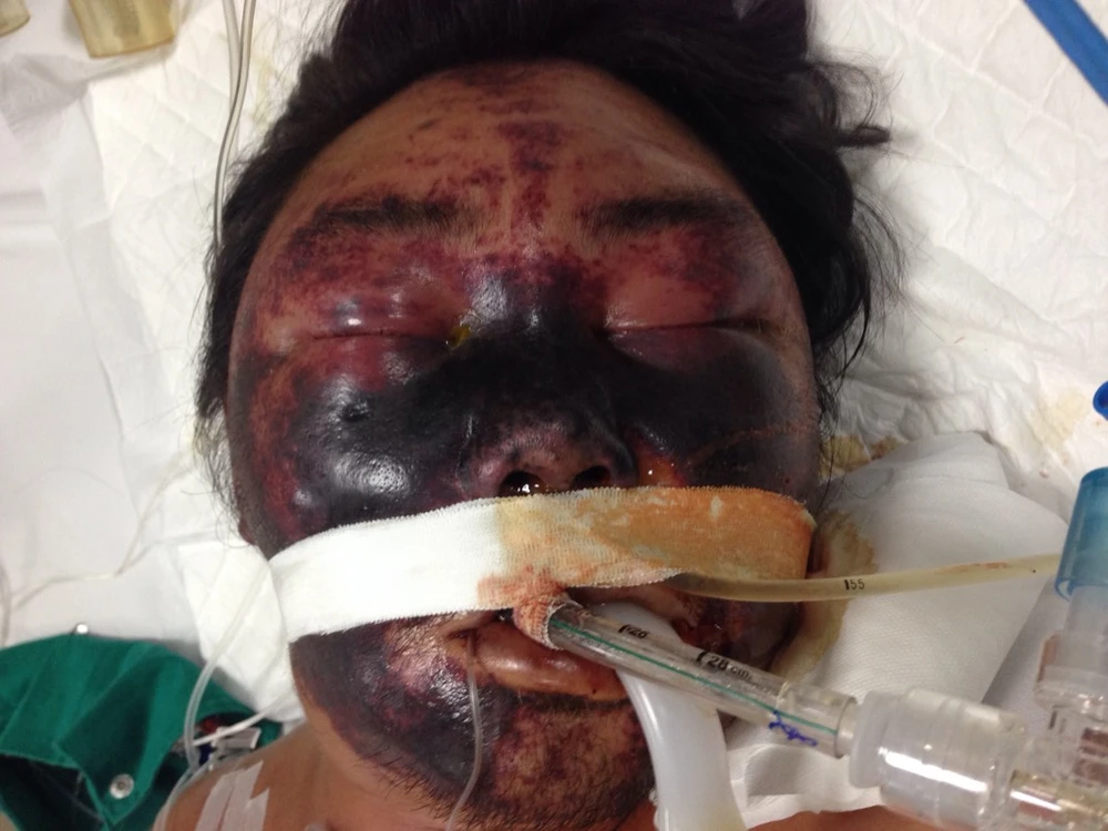 Xin về nhà chờ chết vì dính liên cầu khuẩn do ăn tiết canh lợn 1