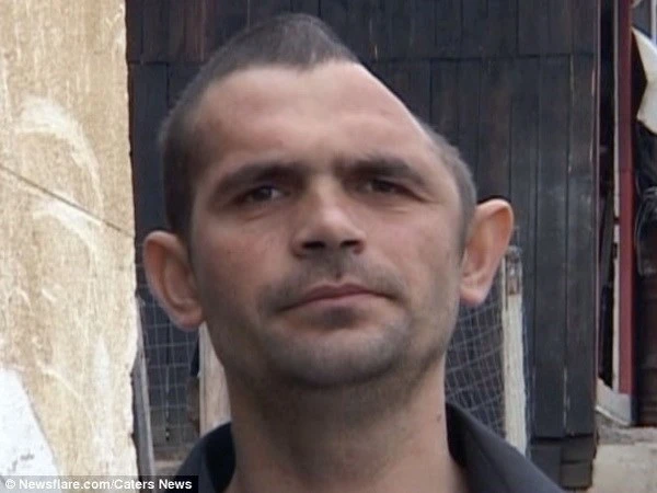 Tái tạo hộp sọ thành công cho người đàn ông mất gần nửa đầu ảnh 2