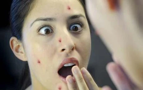 nhìn mụn đoán bệnh