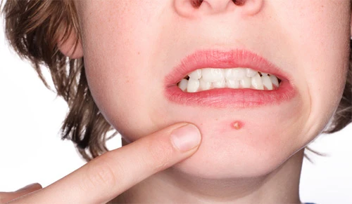 Bị mụn ở 15 vị trí sau sẽ vô cùng nguy hại sức khỏe! ảnh 2 Nhìn mụn đoán bệnh