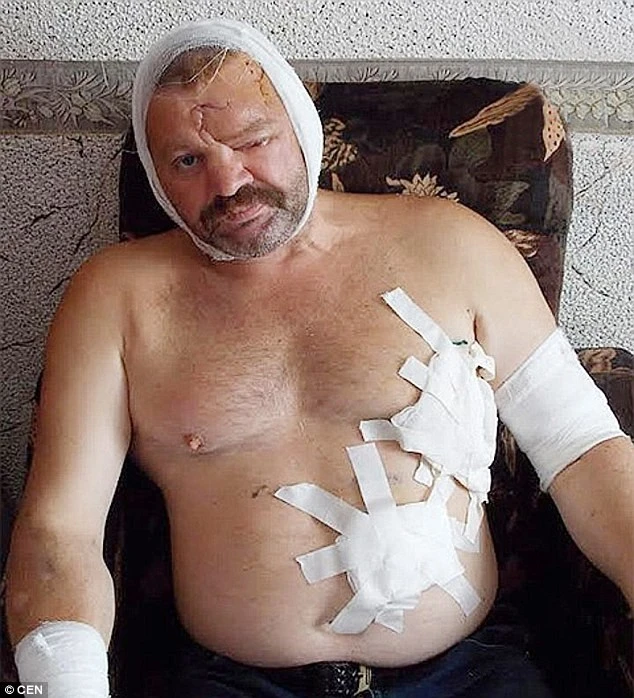 Hình ảnh ngư dân Igor Vorozhbitsyn tại bệnh viện sau tai nạn. Mô tả ảnh.