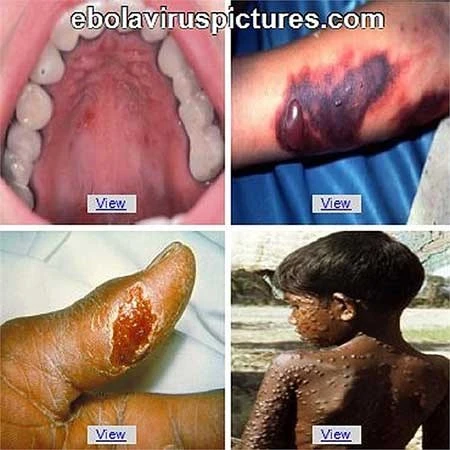 Virus Ebola tấn công cơ thể con người như thế nào? ảnh 4