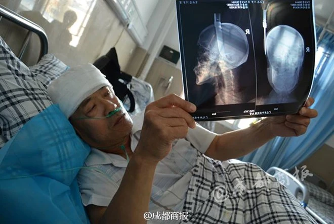 Người đàn ông bị con dao "từ trên trời rơi xuống" cắm thẳng vào đầu ảnh 2 Người đàn ông bị con dao "từ trên trời rơi xuống" cắm thẳng vào đầu ảnh 2