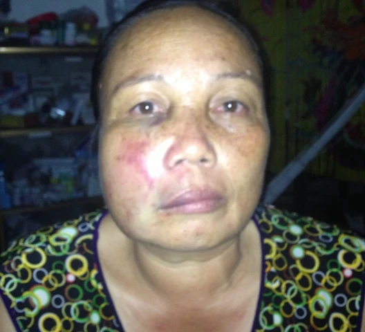 Khuôn mặt của bà Sâm bị ông Phát đánh thâm đen, biến dạng. Ảnh gia đình cung cấp