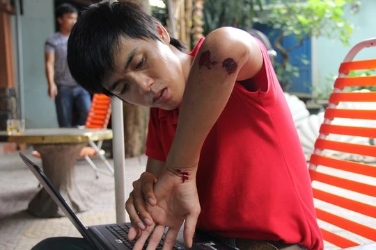 Cộng tác viên Lê Ninh (Báo Tuổi Trẻ) bị đối tượng hành hung gây thương tích