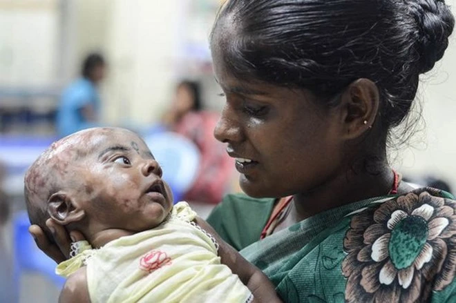 Một bé trai “đột nhiên bốc cháy” 4 lần trong 2 tháng ảnh 1