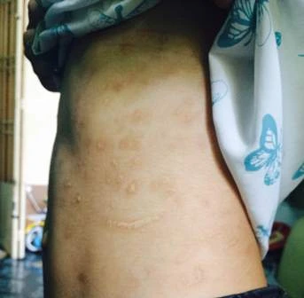 Các vết thẹo chằng chịt trên người em T.