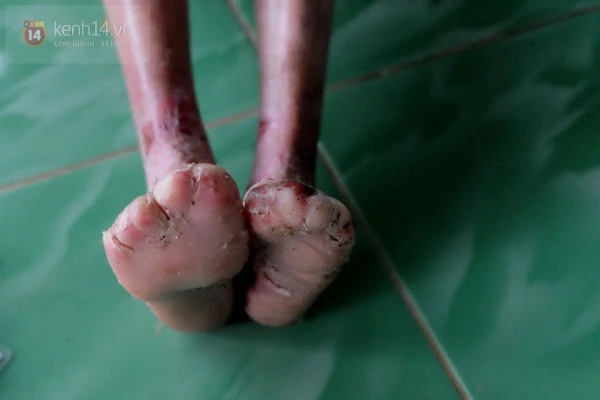 Sự thật câu chuyện bé gái 'bị tạt nước sôi gây lở loét để bắt đi ăn xin' ảnh 4