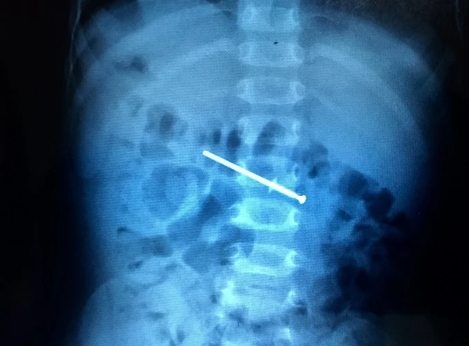 Được bố cho chơi, bé trai 18 tháng tuổi nuốt luôn... cây đinh ảnh 1