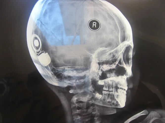 Khánh Hòa: Lần đầu tiên cấy ghép ốc tai điện tử thành công ảnh 1