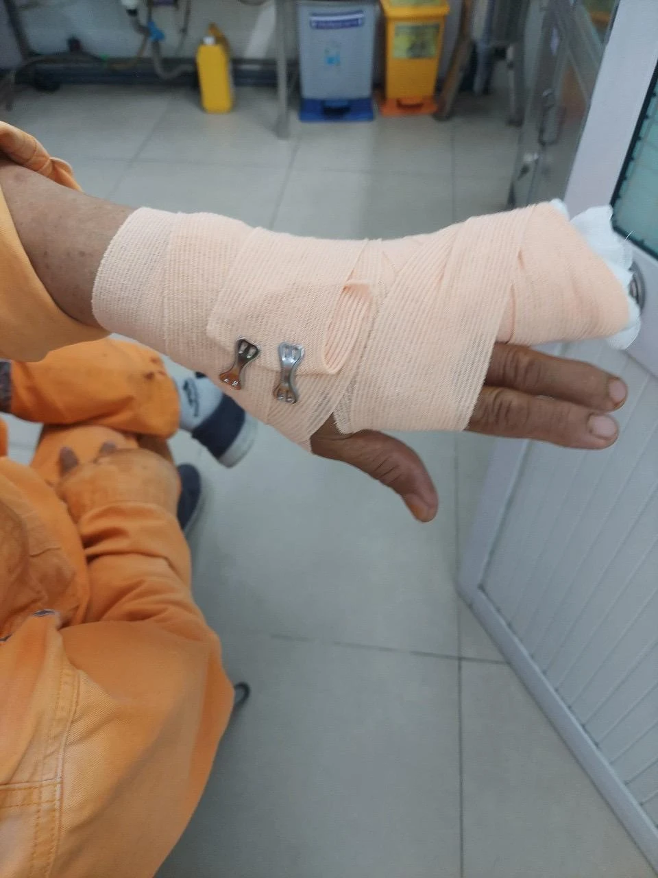 Nhân viên ngành điện bị đánh đứt gân tay. Ảnh: CTV.