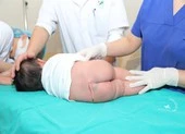 Hy hữu: Cắt đuôi bẩm sinh cho bé 5 tháng tuổi