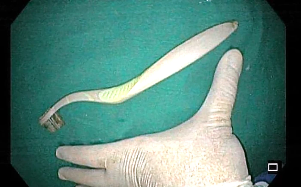 Bàn chải đánh răng dài 20cm được bác sĩ Bệnh viện Đa khoa tỉnh Thanh Hóa sử dụng thủ thuật nội soi gắp từ trong dạ dày của nữ sinh viên ra ngoài. Ảnh: BVĐK