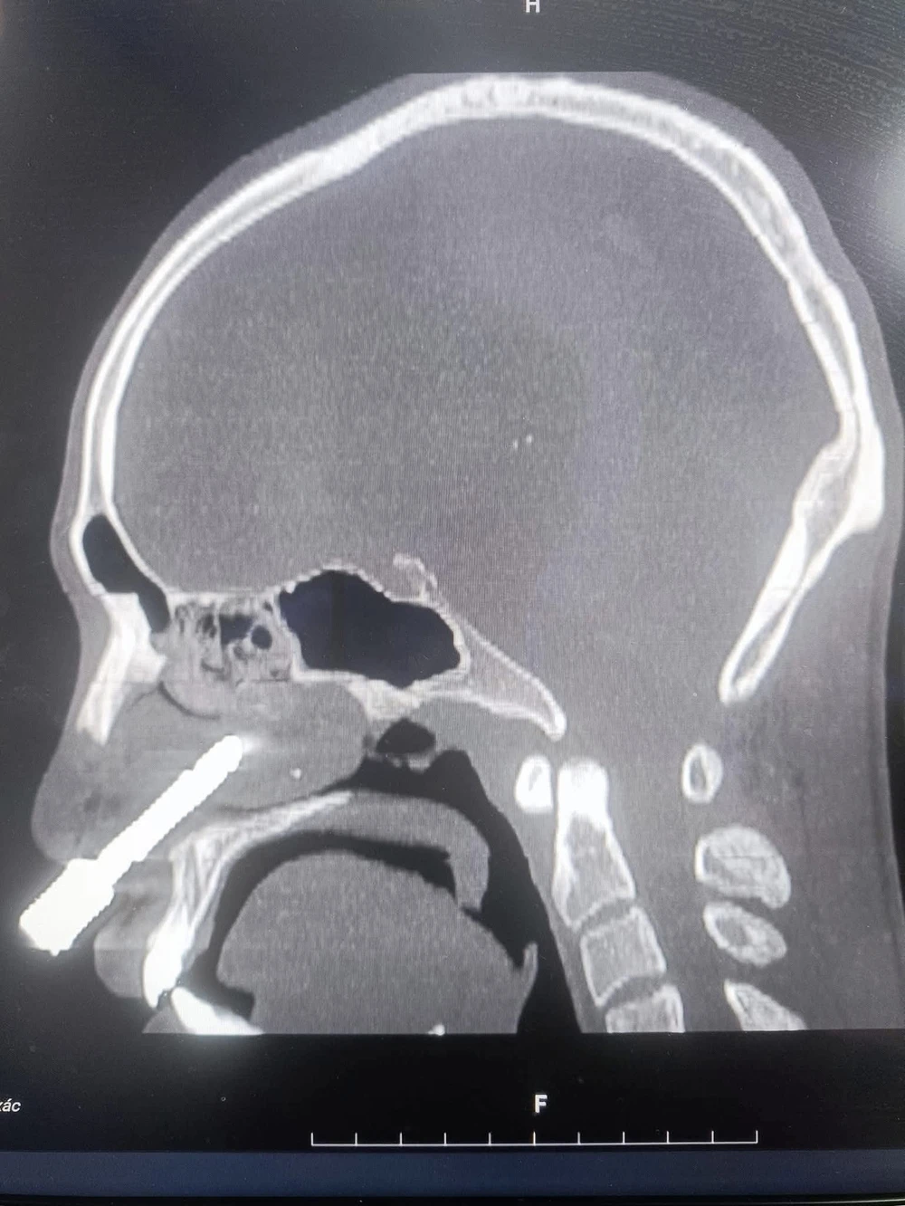 Mũi khoan đá 1.jpeg