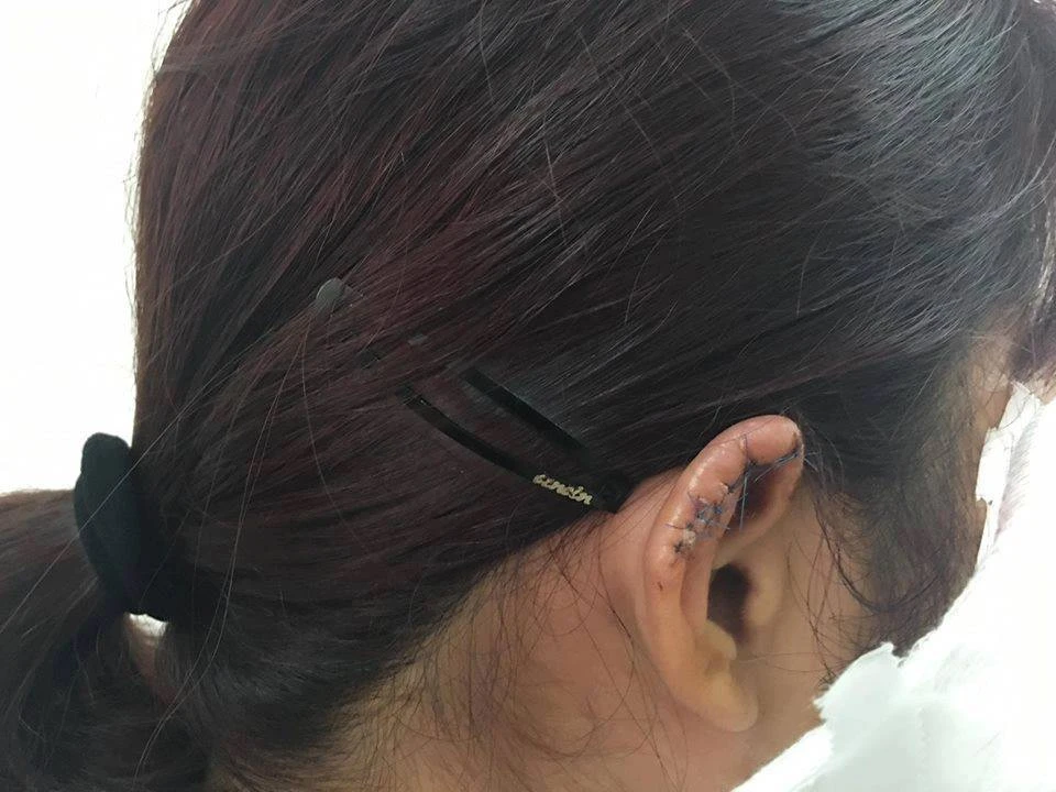 Phụ huynh nói gì khi bị tố cắn đứt tai cô giáo? ảnh 1