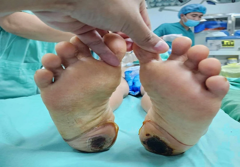 Người phụ nữ suýt bị liệt vĩnh viễn vì tự chữa đau cột sống bằng phương pháp dân gian