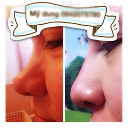 Hoảng hồn dịch vụ tiêm “thần dược” làm đẹp chui tại Hà Nội 1