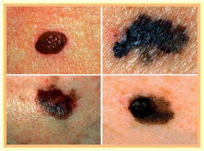 15 dấu hiệu ung thư đàn ông dễ bỏ qua ảnh 4