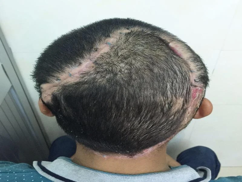 Sau sáu tuần điều trị, xương sọ bị lộ của anh P đã được che phủ và tóc mọc khá nhiều.