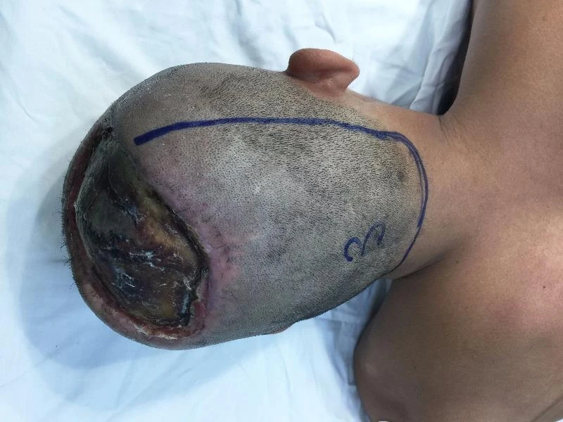 Bệnh nhân P bị mất da đầu, lộ cả xương sọ do bỏng điện.