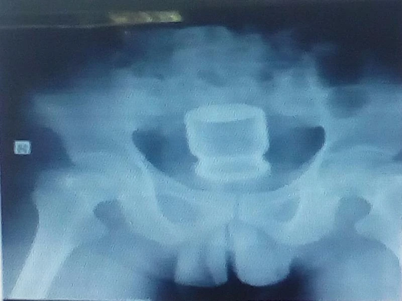 Hình chụp X quang cho thấy lọ nước yến nằm sâu trong hậu môn của ông L. 