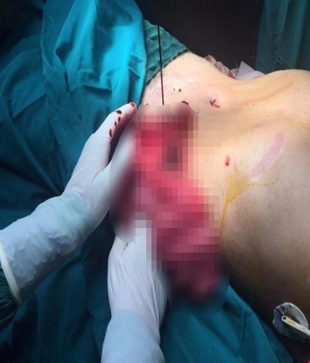 máy cưa chém thủng bụng