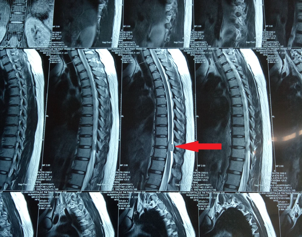Phẫu thuật thành công cho bệnh nhân u tủy sống ngực ảnh 1