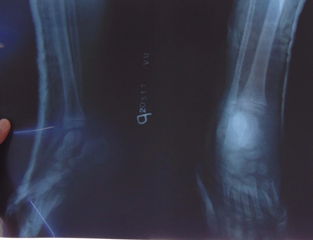 Rách da, gãy gót do kẹt chân vào căm xe máy ảnh 1