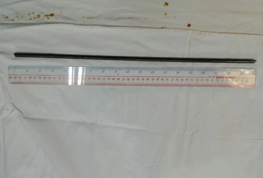 Cây sắt đâm từ đùi xuống mắt cá chân trái cô gái ảnh 2