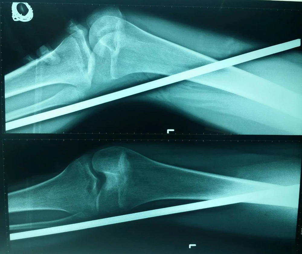 Cây sắt đâm từ đùi xuống mắt cá chân trái cô gái ảnh 1