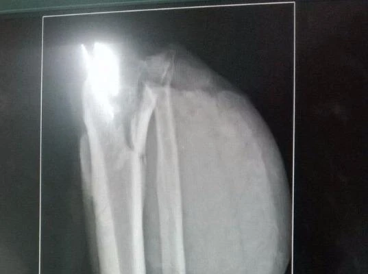 Kết quả chụp X quang ghi nhận đùi chân trái ông D bị đứt lìa.