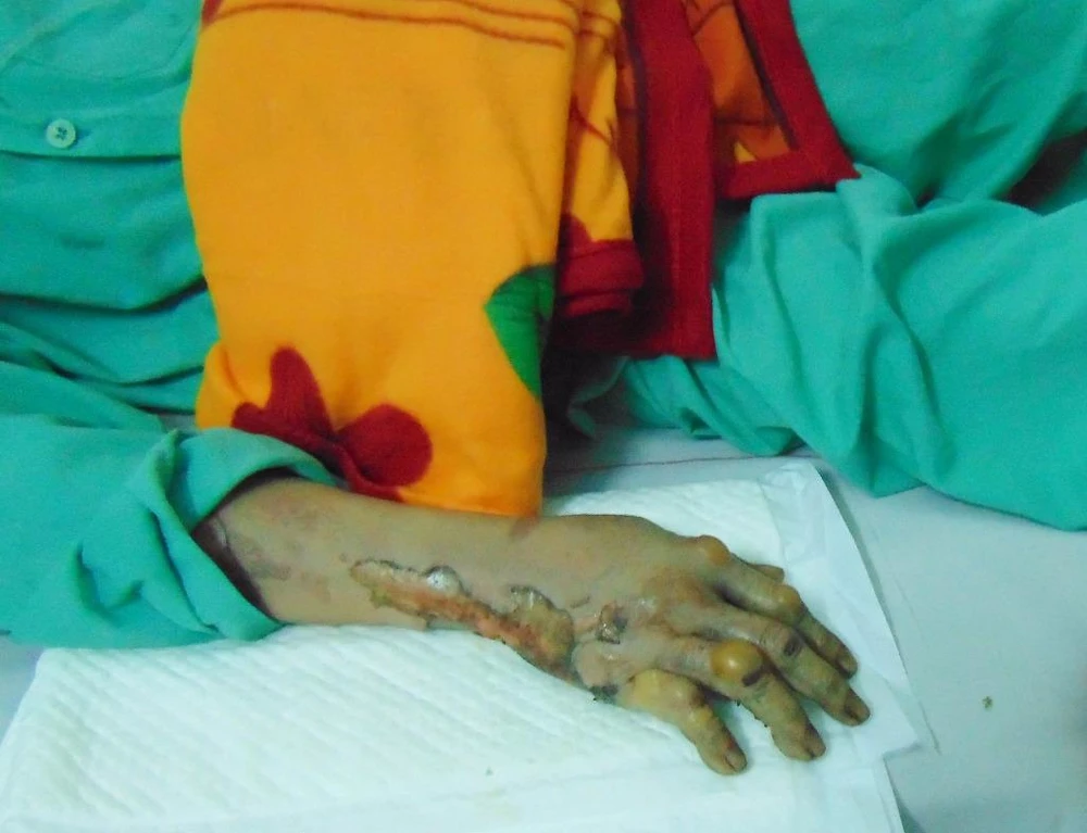 Tay phải của bà DT bị phỏng.