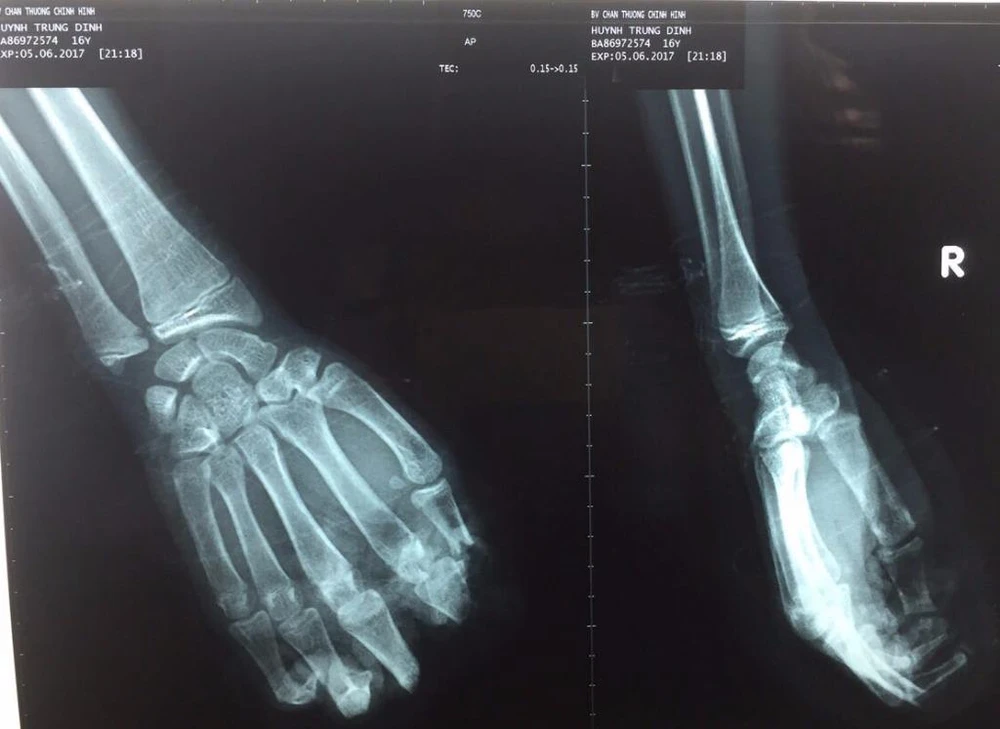Kết quả chụp X quang cho thấy bốn ngón tay của em D bị đứt lìa.