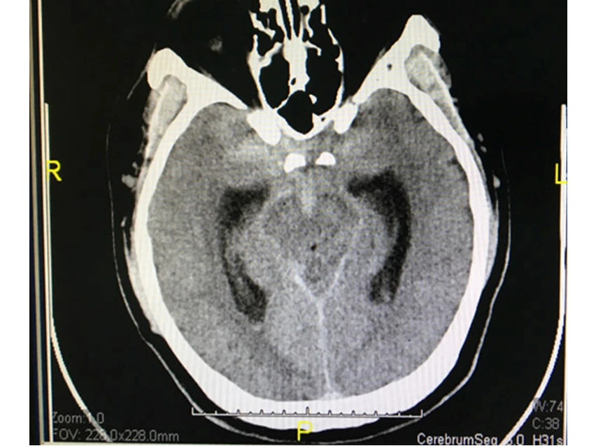 Tưởng đau đầu do làm đêm, té ra bị xuất huyết màng não ảnh 1