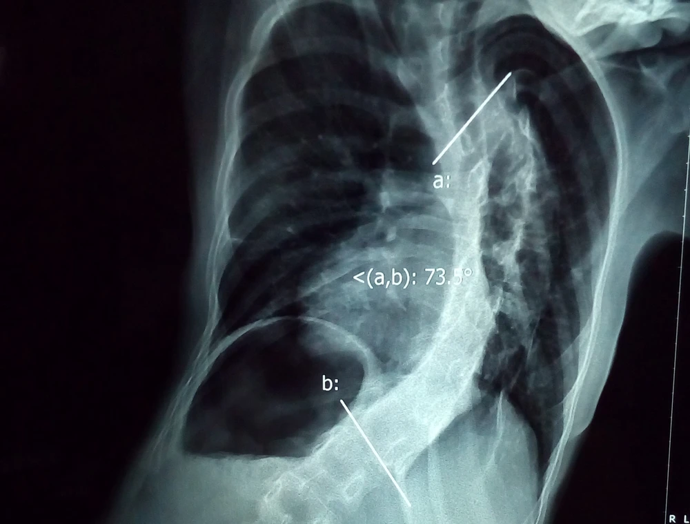 Cột sống bệnh nhi cong hình chữ S. Ảnh: HÒA KHÁNH