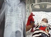 Bé 2 tháng tuổi phổi trắng xóa vì nhiễm lao từ cha 