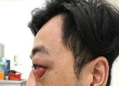 Chàng trai đột nhiên lồi mắt, suýt mù sau 2 năm bị té