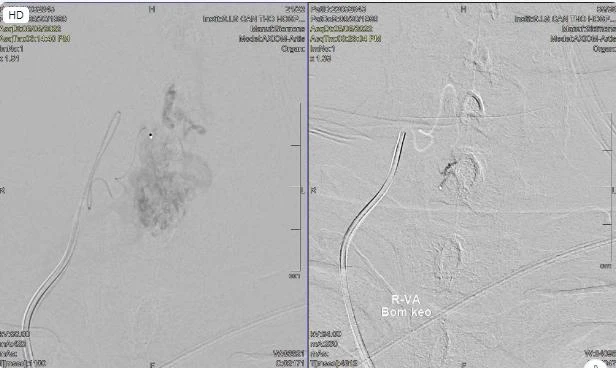 Hình chụp cho thấy anh Đ. bị dị dạng mạch máu tủy. Ảnh: BVCC