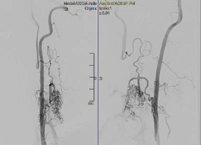 Hình ảnh mạch máu tủy của anh Đ. sau khi được can thiệp. Ảnh: BVCC