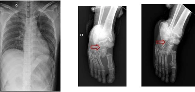 Chụp X quang cho thấy nhiều xương ngực và chân phải anh H. bị gãy. Ảnh: BVCC
