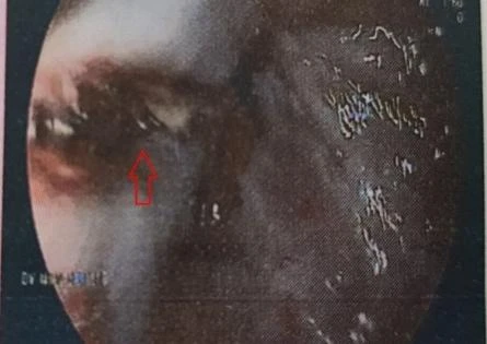 Nội soi dạ dày cho thấy thực quản ông M. bị vỡ. Ảnh: BVCC