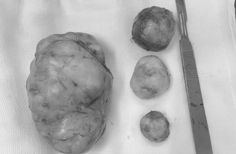 Bốn khối u to bất thường được bóc tách từ lòng tử cung bà P. Ảnh: BVCC