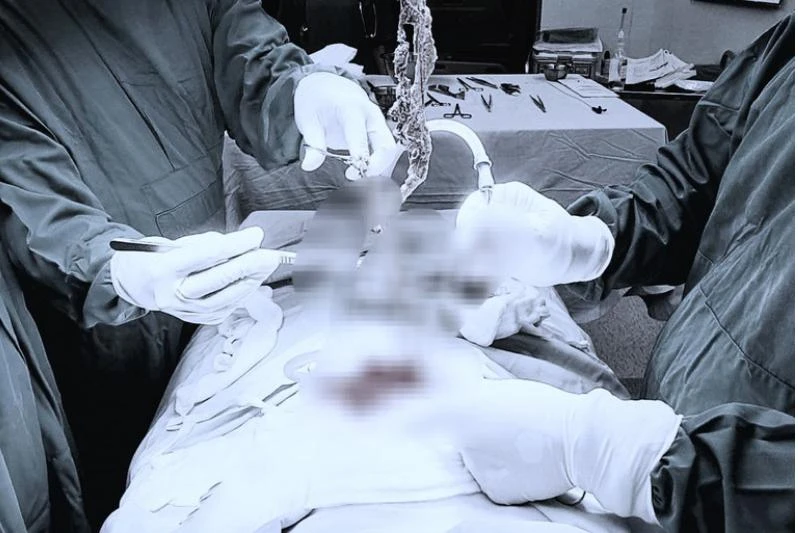 Các bác sĩ đang phẫu thuật lấy búi tóc cho một trẻ. Ảnh: BVCC Các bác sĩ đang phẫu thuật lấy búi tóc cho một trẻ. Ảnh: BVCC