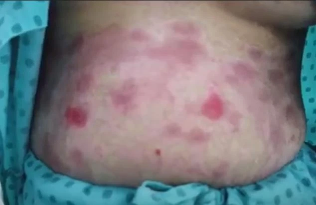 Da chị H xuất hiện nhiều ban đỏ do hoại tử thượng bì nhiễm độc nặng. Ảnh: BVCC