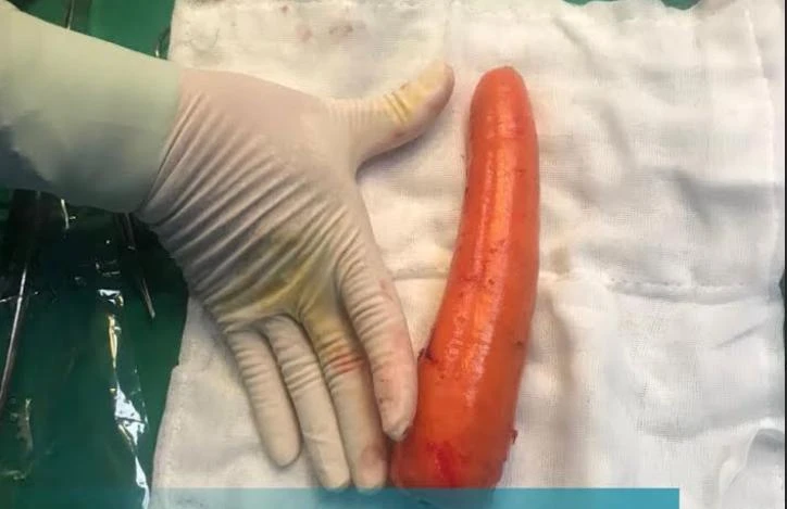 Bệnh nhân đút cà rốt vào hậu môn để tìm cảm giác lạ. Ảnh: BVCC
