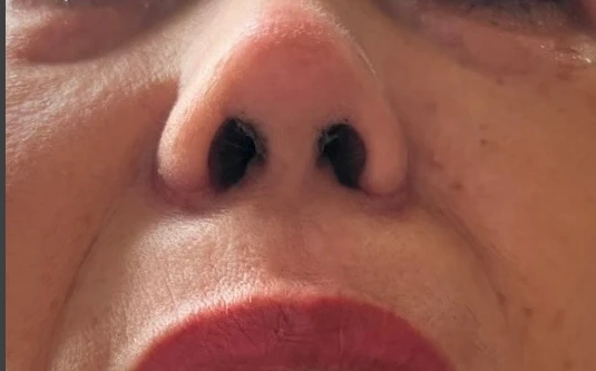 Mũi bà H sưng to, gây đau nhức sau khi "được" chủ nhà nâng. Ảnh: BVCC