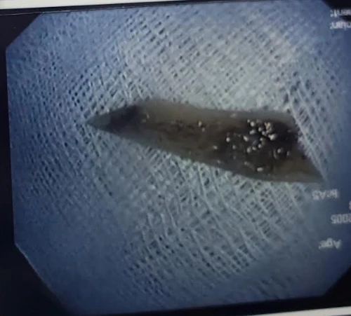 Mẩu xương vịt có kích thước lớn với hai đầu sắc nhọn. Ảnh: BVCC