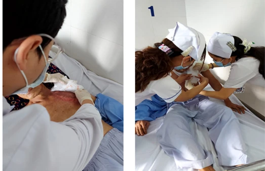 Các vết bỏng của ông C đã lành. Ảnh: BVCC