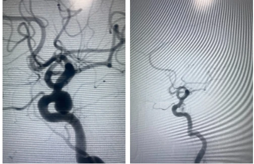 Mạch máu não sau khi được can thiệp. Ảnh: BVCC